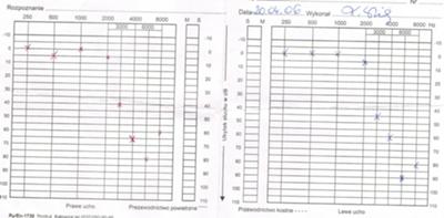 Audiogram osoby z niedosłuchem Audiogram osoby z niedosłuchem